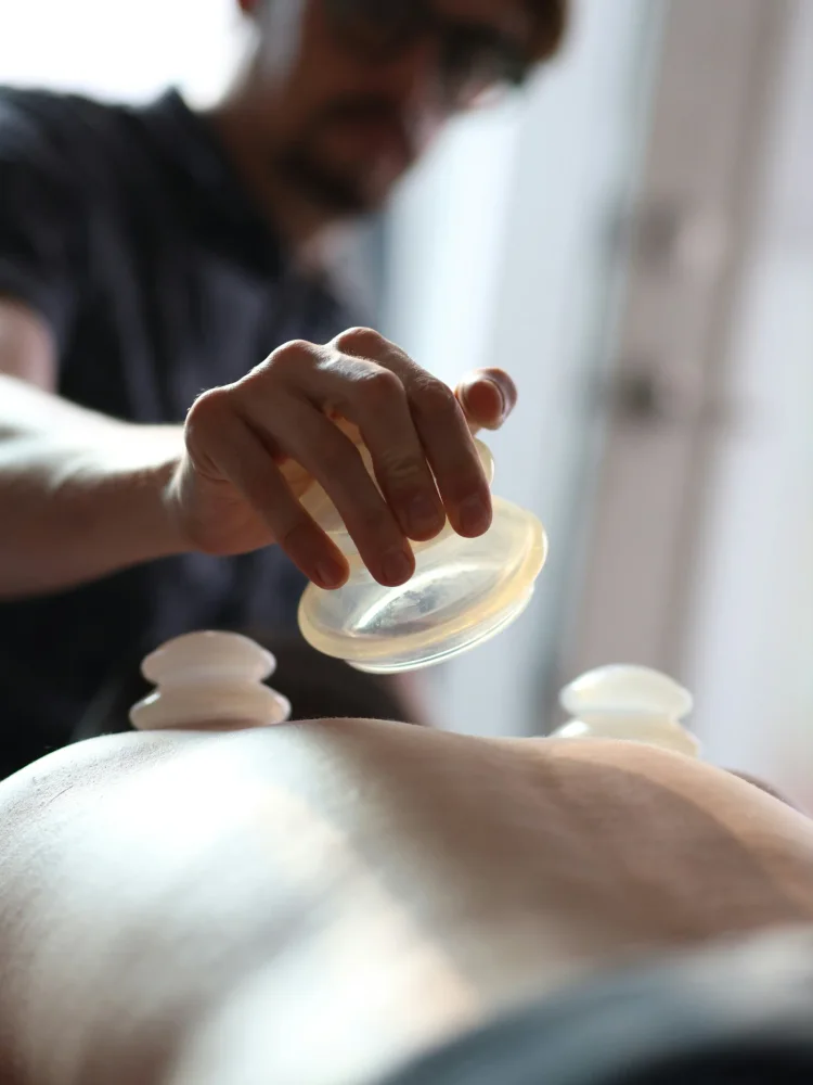 cupping therapy